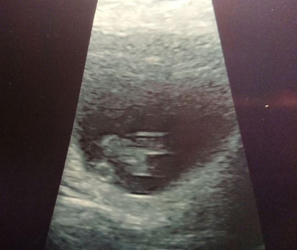 September 2018: #3! Early scans and booking in... it's all getting very real!