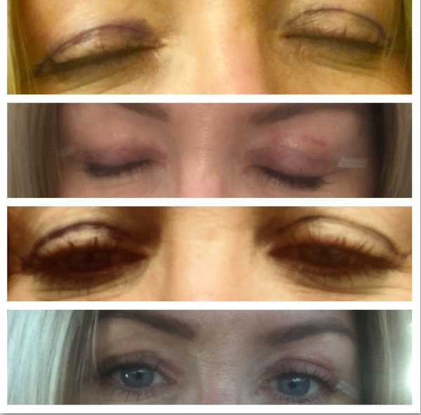 Hooded eyes, what are the options?