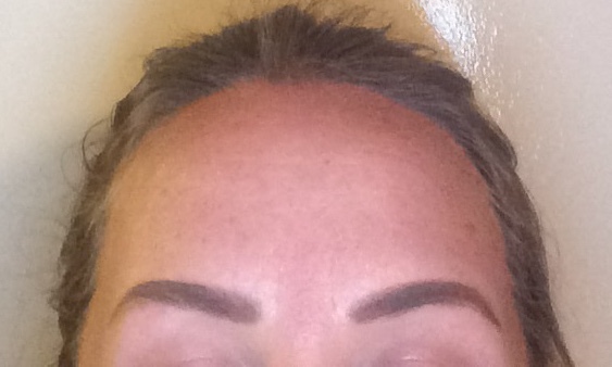 Deep wrinkles at aged 32- help!