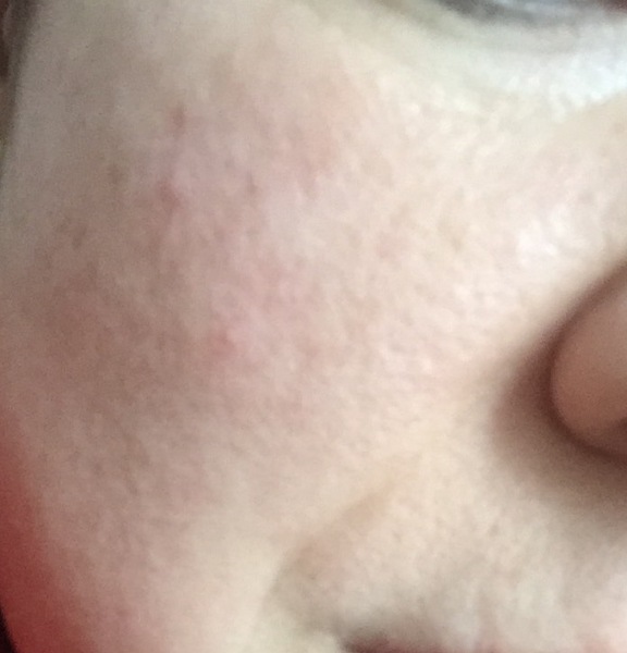 Is this rosacea?