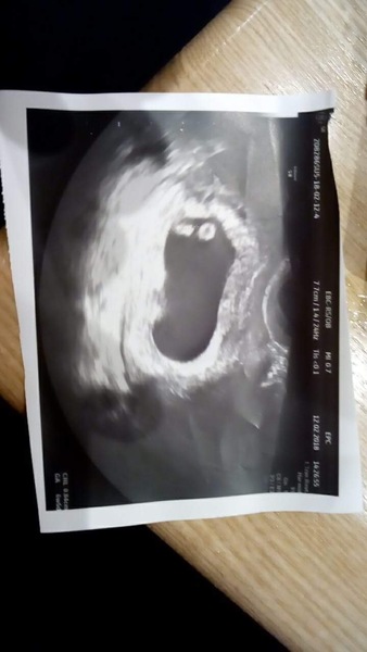 Why aren’t there two white masses on my friends 7 week scan?