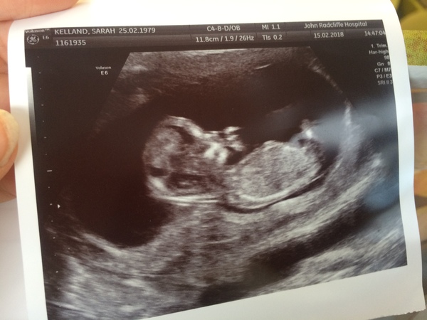 September 2018: #3! Early scans and booking in... it's all getting very real!