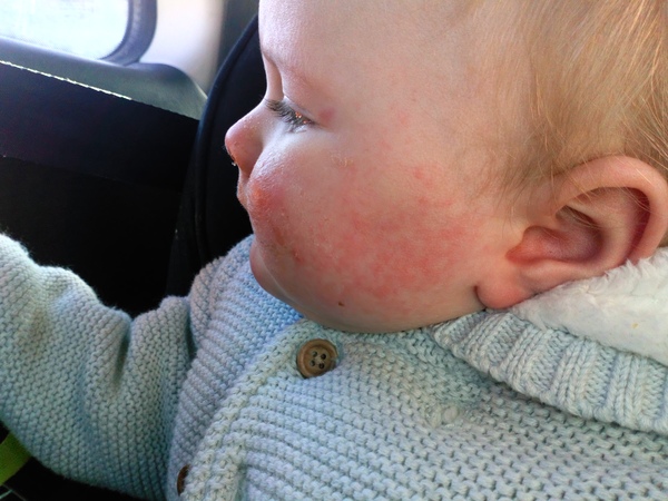 Rash on my babys cheeks!? (Picture)