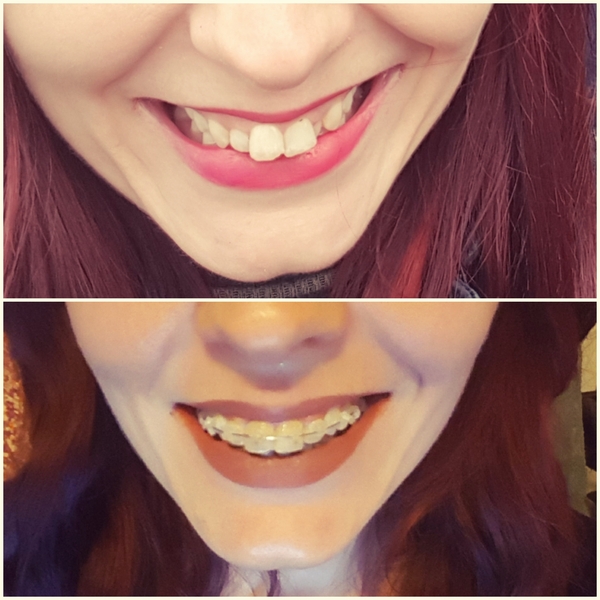 Has anyone had braces as an adult?