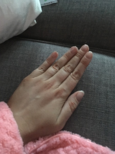 Injured hand
