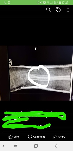 AIBU to think this fracture isn't set right?