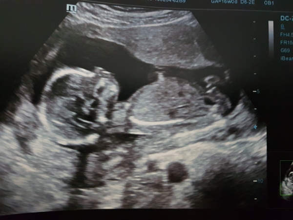 Posifrickentive into 2018 - thread 20 for those pregnant after mc