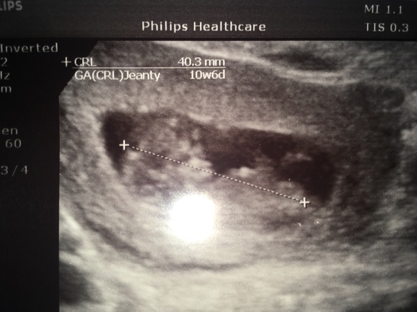 September 2018 #4: 12 weeks scans and bumps appearing!