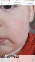 8 month old rash / dry skin