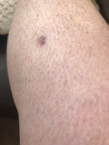 Purple-ish spots on legs for over 6 months?