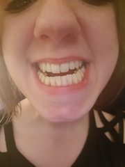 To get braces? any dentists advise? (Photo attached)
