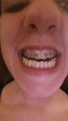 To get braces? any dentists advise? (Photo attached)