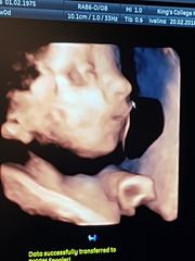 CDH - Congenital Diaphragmatic Hernia
