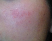 Please help - what is this read, itchy, dry patch on my face?
