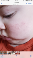 8 month old rash / dry skin