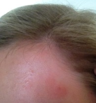 Please help - what is this read, itchy, dry patch on my face?