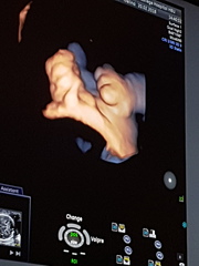 CDH - Congenital Diaphragmatic Hernia
