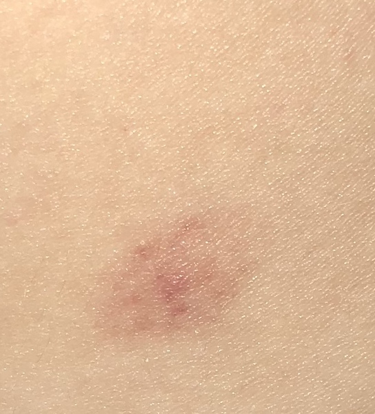 Chickenpox without blisters????