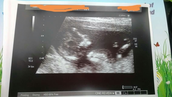 September 2018 #4: 12 weeks scans and bumps appearing!