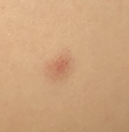 Chickenpox without blisters????