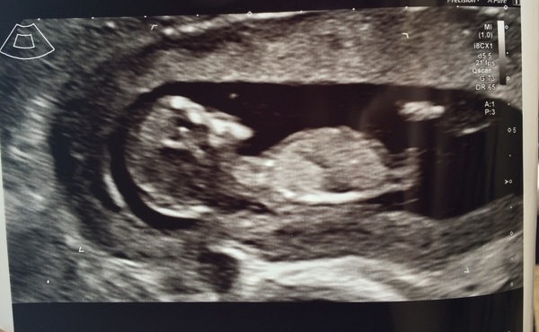 September 2018 #4: 12 weeks scans and bumps appearing!