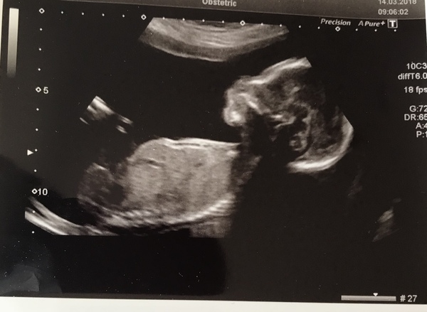 20 week scan tomorrow and scared