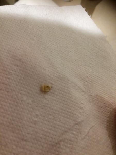 Does anyone want to see a bazooka'd verrucca?