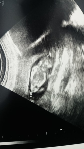 11 week scan - boy or girl?