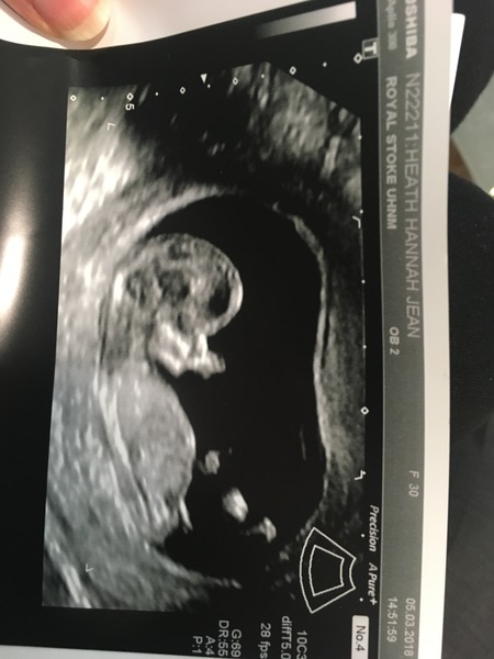 September 2018 #4: 12 weeks scans and bumps appearing!