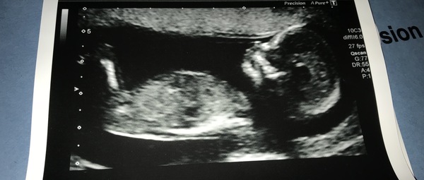 September 2018 #4: 12 weeks scans and bumps appearing!