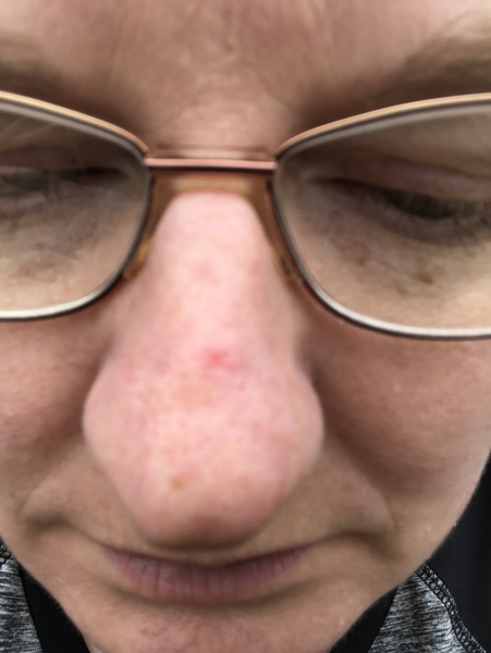 Does this look like Basal cell on my nose?