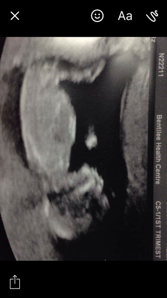 September 2018 #4: 12 weeks scans and bumps appearing!