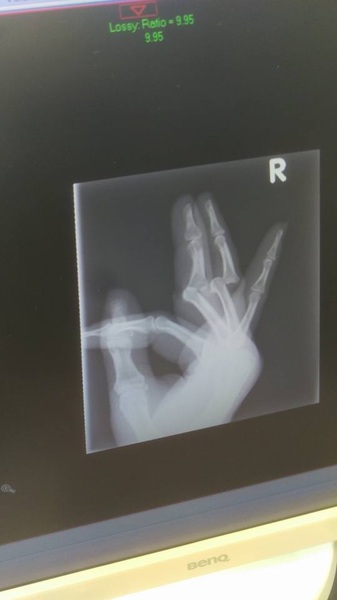 What has been your strangest injury? (Warning! Thread contains gory images)