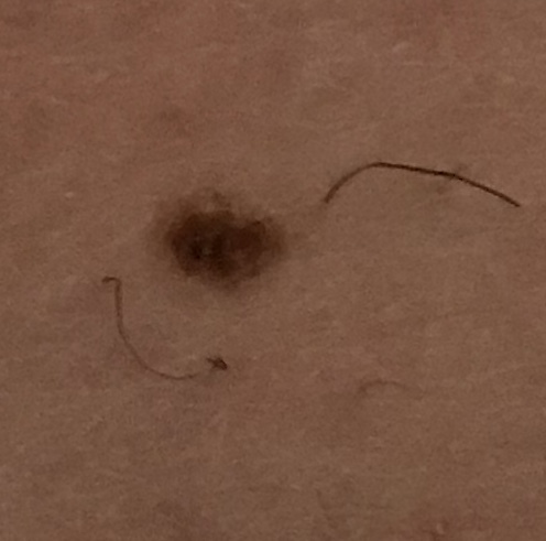 Moles Help - Pic Included