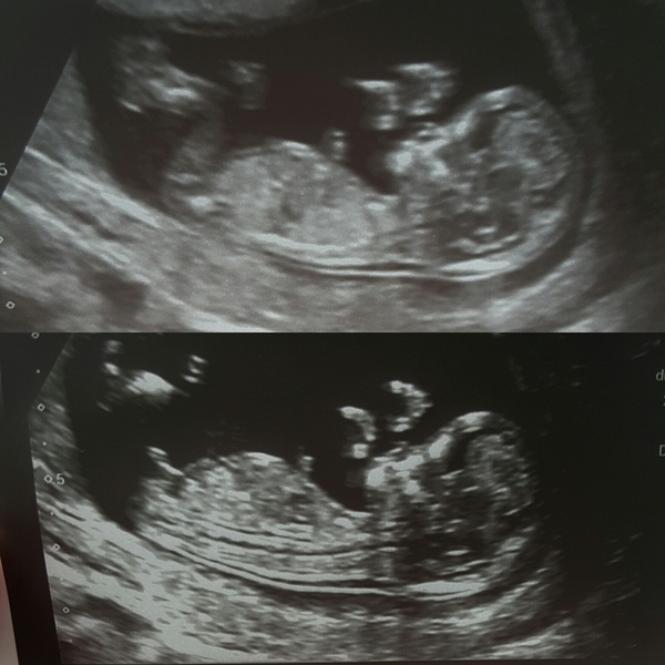 September 2018 #4: 12 weeks scans and bumps appearing!