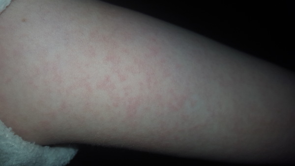 What could this rash be?