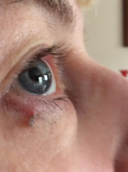 Skin tag self removal