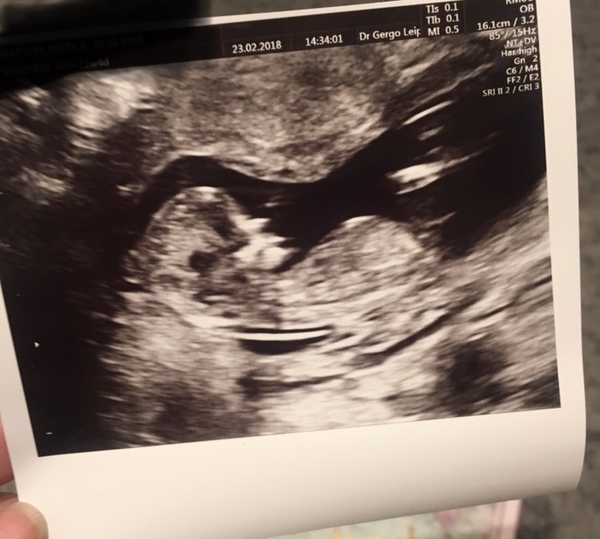 September 2018 #4: 12 weeks scans and bumps appearing!