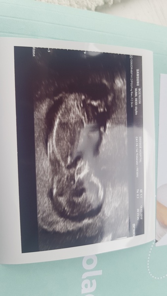 13 weeks scan pics-  anyone fancy a guess at the sex?
