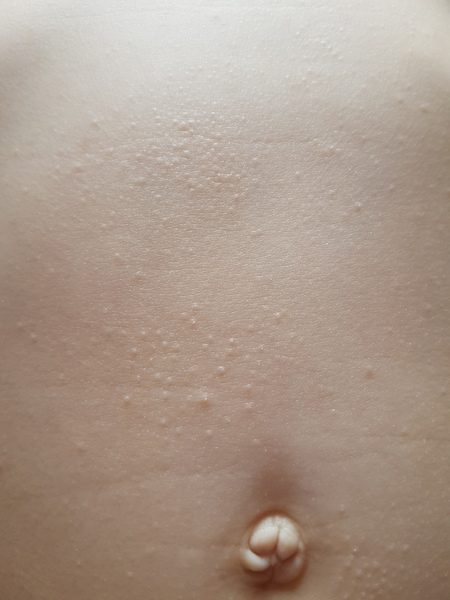 Rash