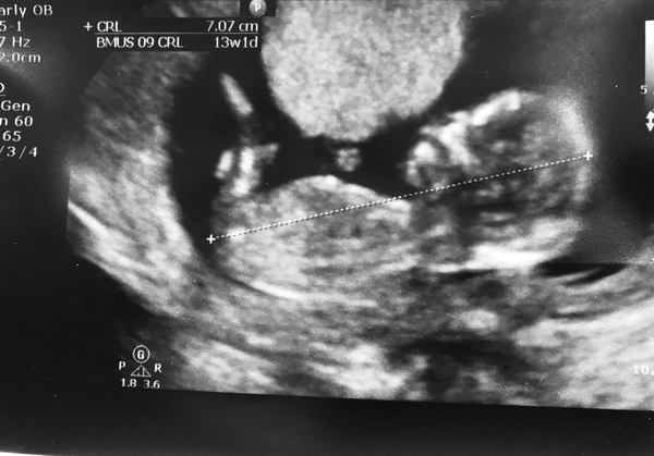 September 2018 #4: 12 weeks scans and bumps appearing!