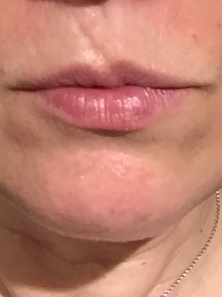 What would you do about this facial scar?