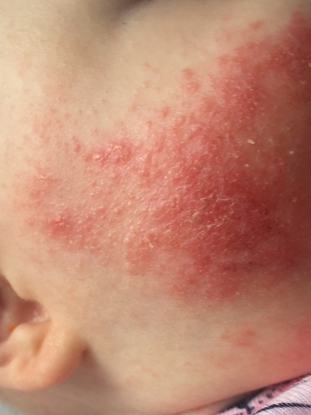 Eczema - at the end of my emollient-covered rope