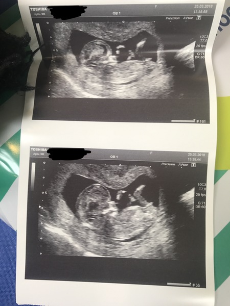 Boy or girl? Loads of pics
