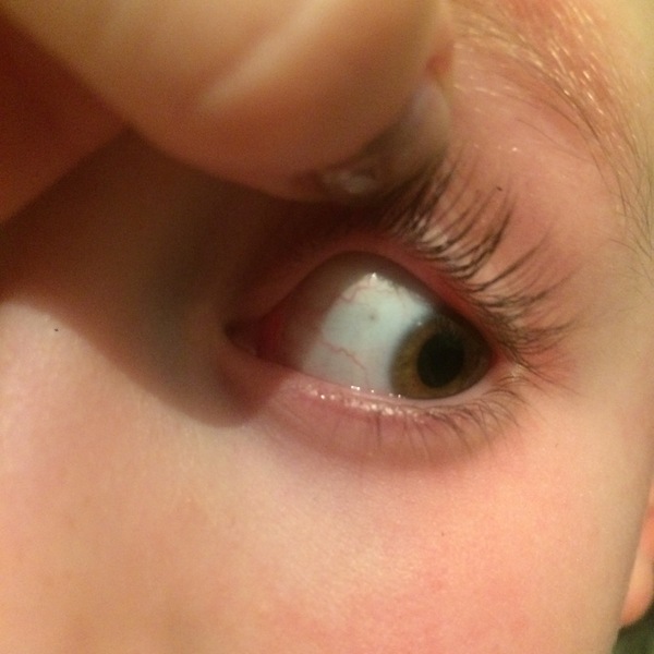 Small black shadow on sons eye