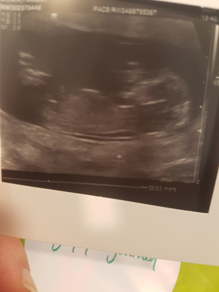 September 2018 #4: 12 weeks scans and bumps appearing!