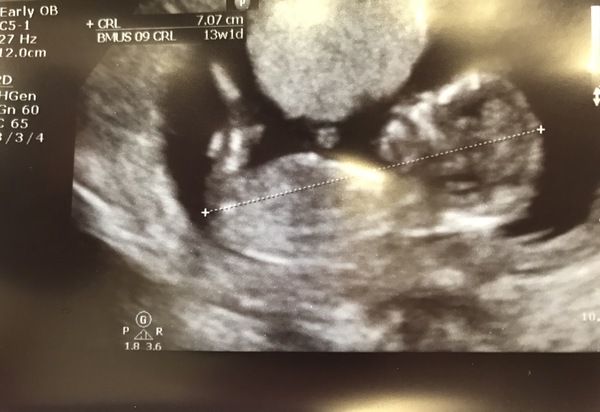 September 2018 #4: 12 weeks scans and bumps appearing!