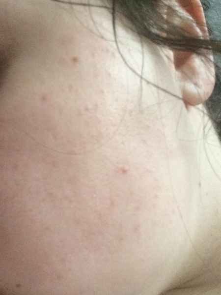 Rash on DS2