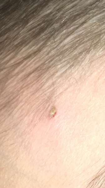 DS has a wonderful spot and he won’t let me squeeze it (pic)