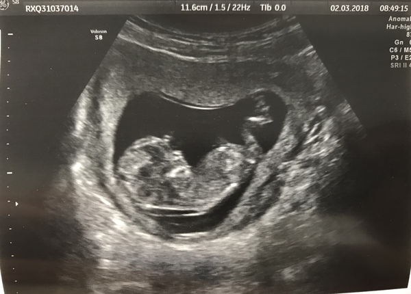 Gender prediction... can anyone guess?